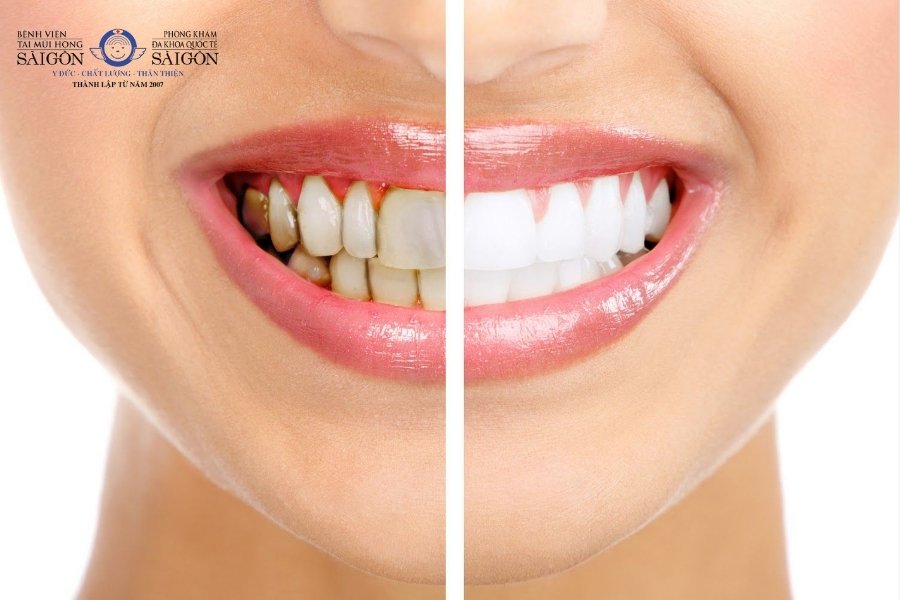 chat-lieu-cao-cap-mang-den-ham-rang-sang-dep-1